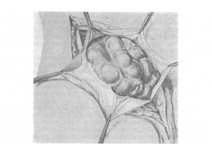 Хирургия грыж брюшной стенки - any2fbimgloader83.jpeg