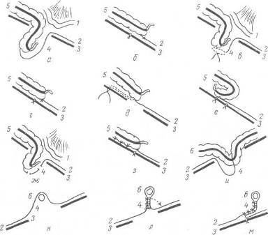 Хирургия грыж брюшной стенки - any2fbimgloader85.jpeg